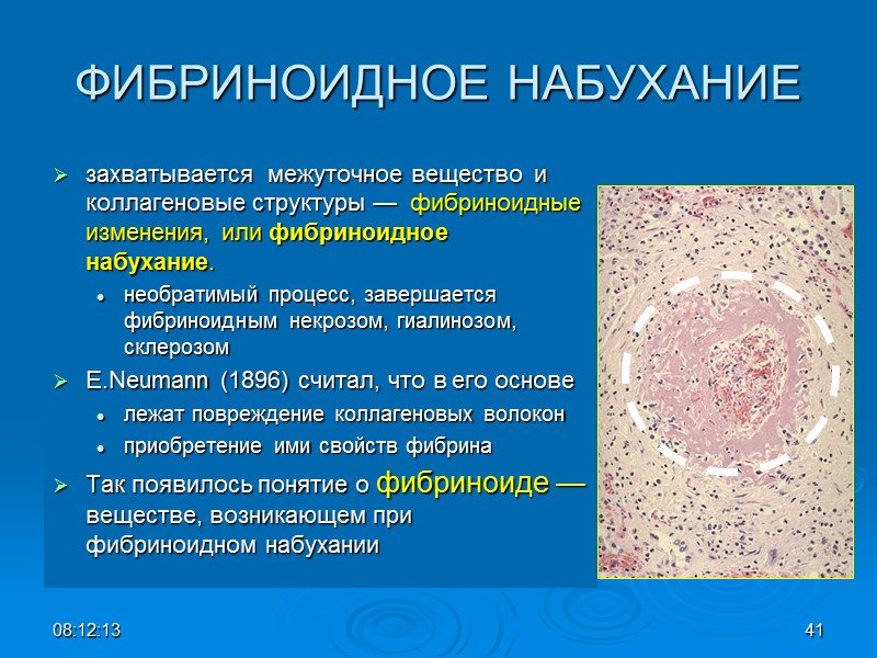 ФИБРИНОИДНОЕ НАБУХАНИЕ захватывается  межуточное вещество  и коллагеновые структуры —  фибриноидные изменения,